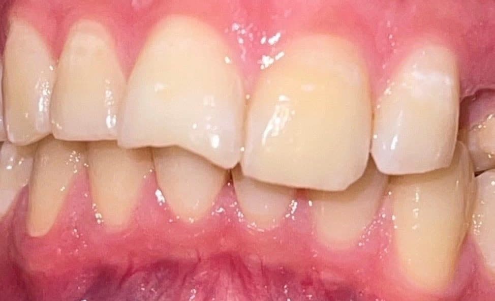 Nahaufnahme von Zähnen vor einer Parodontose Laser Therapy mit sichtbaren Zahnfleischerkrankungen.