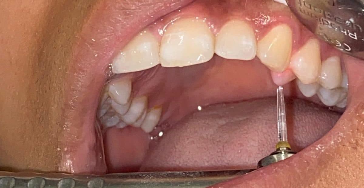Nahaufnahme einer Zahnfüllung während der Individuellen Laser Füllungs Therapy.
